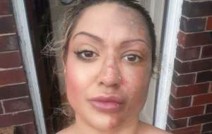 O femeie s-a ales cu jumătate de față arsă după ce a încercat un truc viral pe TikTok. „Am fost într-o agonie absolută”