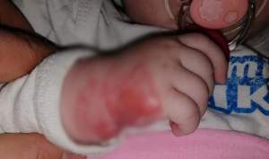 Revoltător! O fetiță de 5 luni a făcut o alergie severă în spital după ce bandajul de la branulă nu i-a fost schimbat timp de o săptămână
